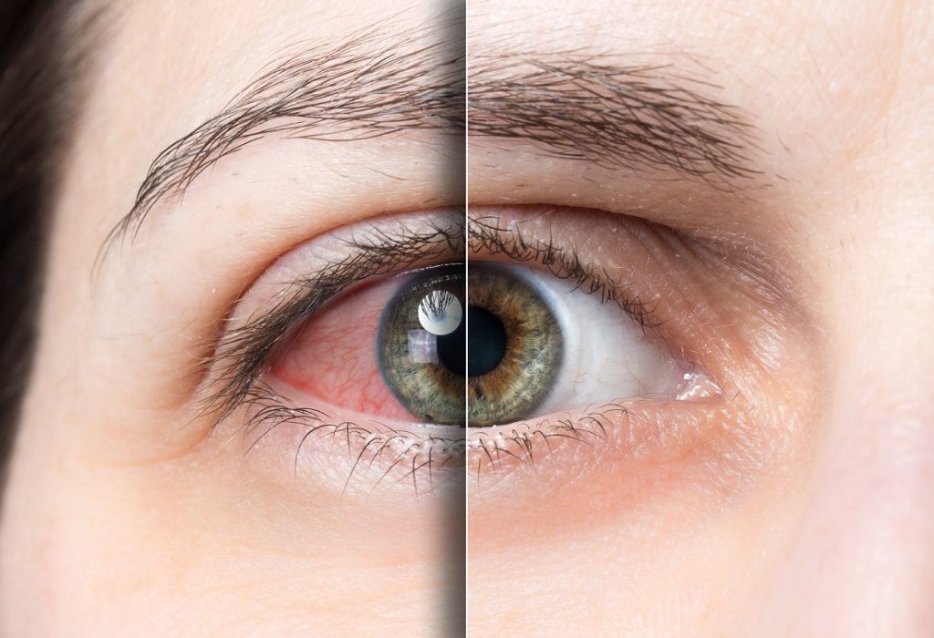 Dry Eyes and poor retinal function - Omega 3