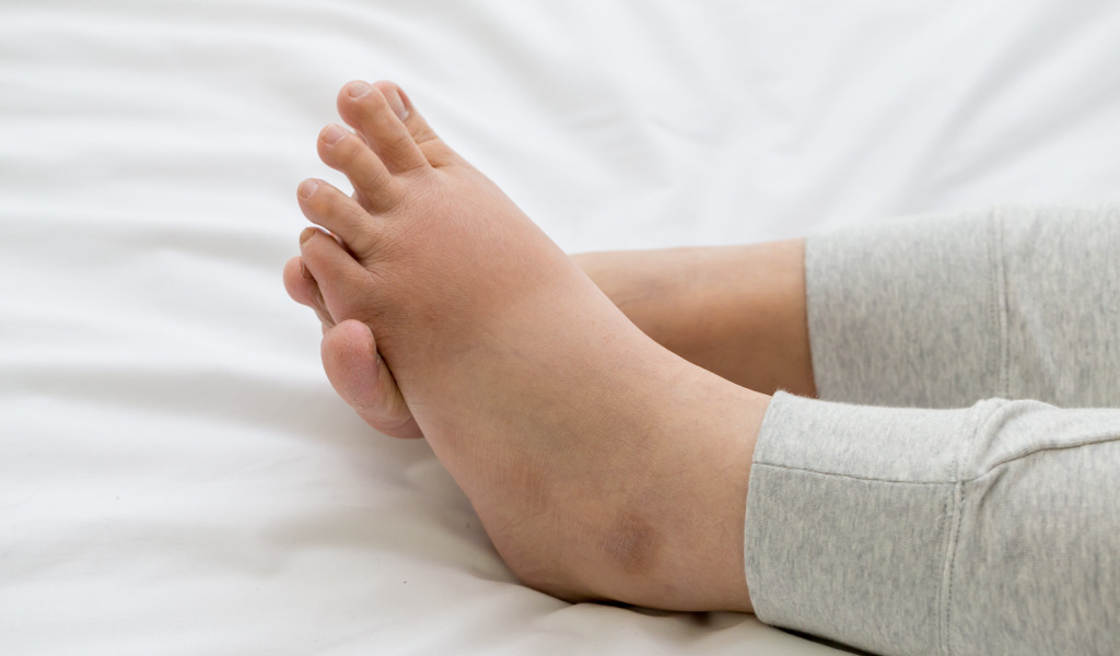 Swelling in the legs ankles or feet