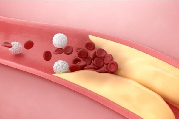 myocardial infarction