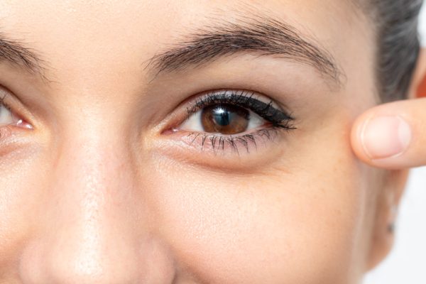 Crows feet